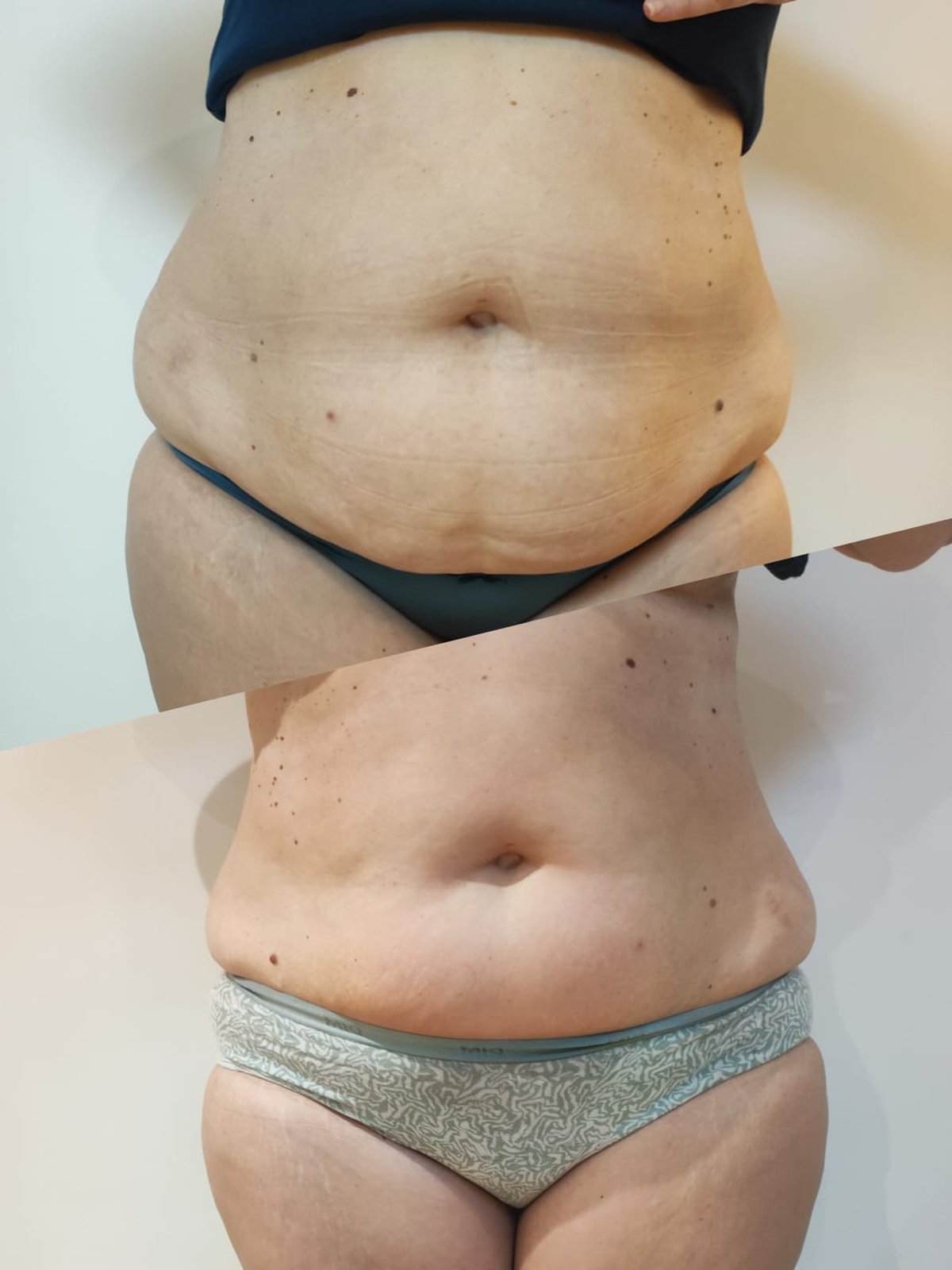 Avant/après lymphomodelage visage