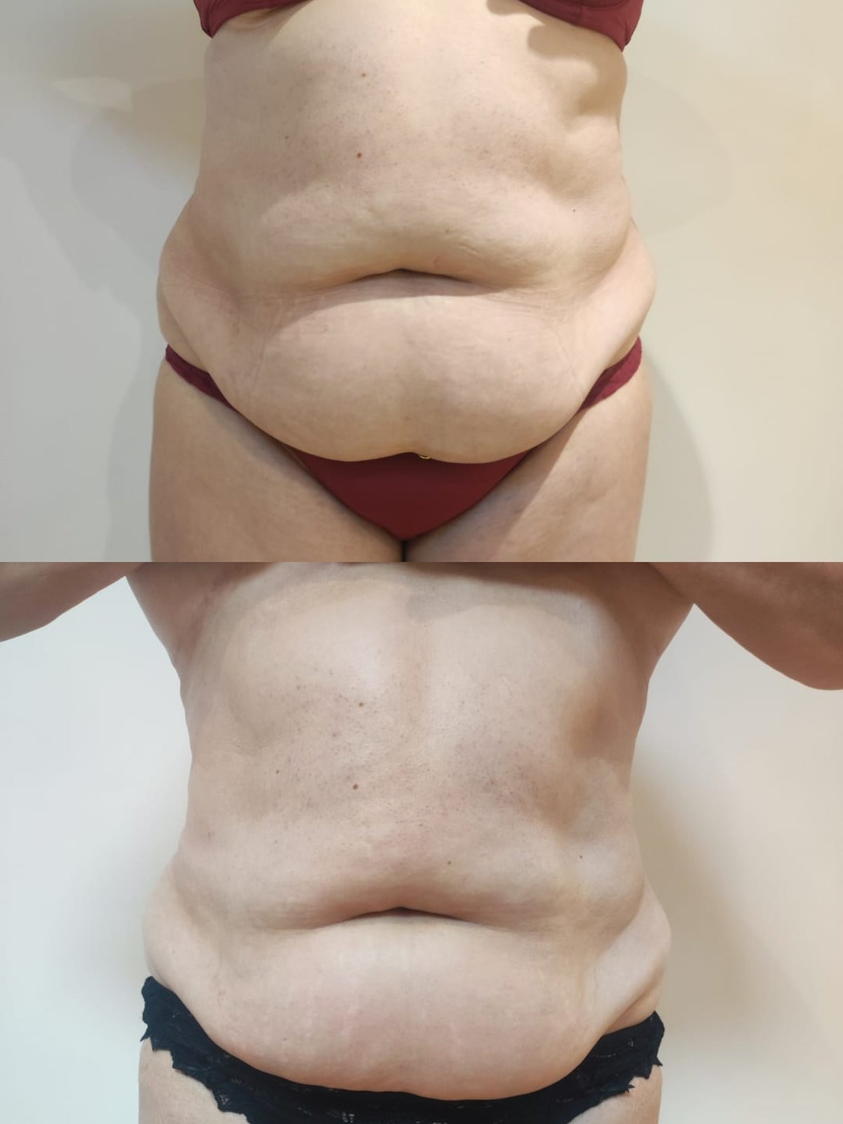 Avant/après drainage lymphatique professionnel